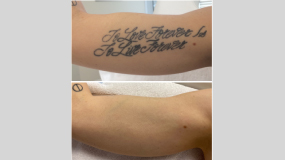 Before and After Pictures | Laser Tattoo Removal