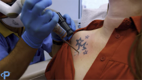 How Laser Tattoo Removal Works